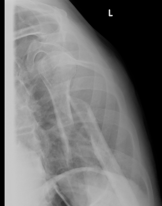Displaced Humeral Fracture Lateral